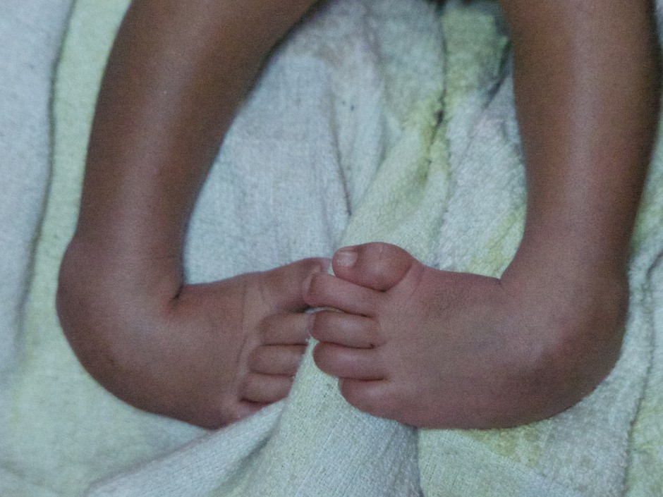 A child with clubfoot. Photo: Lynn Staheli