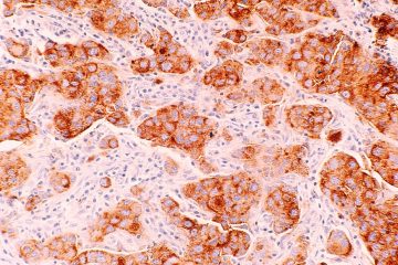 Microscopic image of breast cancer (Ductal Carcinoma). Single-cell genome sequencing provides new insights into deadly cancers.
